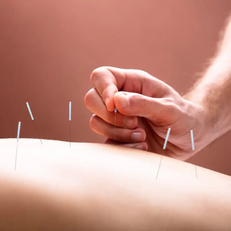 Chiropractor Melbourne performing dry needling on mid-back to relieve muscle tension
