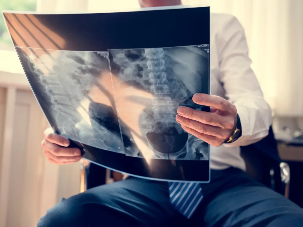 Chiropractor Melbourne reviewing spinal X-rays for lower back and sciatica pain